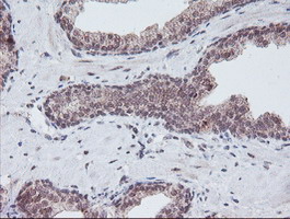 PGAM2 Antibody - IHC of paraffin-embedded Carcinoma of Human prostate tissue using anti-PGAM2 mouse monoclonal antibody. (Heat-induced epitope retrieval by 10mM citric buffer, pH6.0, 100C for 10min).