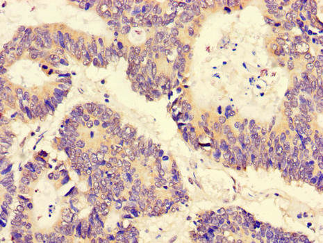 PGAM5 Antibody - Immunohistochemistry of paraffin-embedded human colon cancer using CSB-PA839336LA01HU at dilution of 1:100