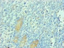 PGC / Pepsin C Antibody - Immunohistochemical of paraffin-embedded human gastric cancer tissue using PGC Monoclonal Antibody at dilution of 1:200