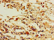 PGIS / PTGIS Antibody - Immunohistochemistry image of paraffin-embedded human melanoma cancer at a dilution of 1:100