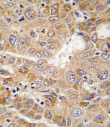 PGK1 / Phosphoglycerate Kinase Antibody - Formalin-fixed and paraffin-embedded human hepatocarcinoma tissue reacted with PGK1 antibody , which was peroxidase-conjugated to the secondary antibody, followed by DAB staining. This data demonstrates the use of this antibody for immunohistochemistry; clinical relevance has not been evaluated.