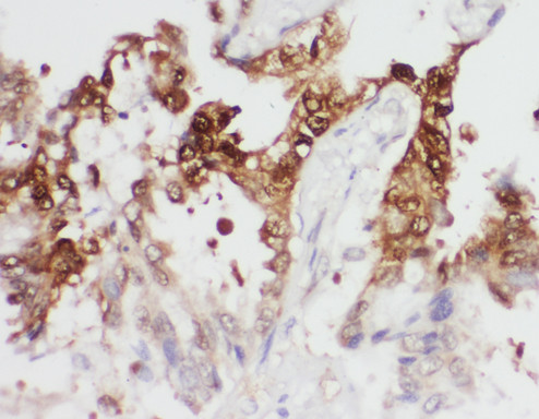 PGK1 / Phosphoglycerate Kinase Antibody - PGK1/Phosphoglycerate Kinase 1 antibody. IHC(P): Human Lung Cancer Tissue.