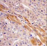 PGK1 / Phosphoglycerate Kinase Antibody - Formalin-fixed and paraffin-embedded human hepatocarcinoma tissue reacted with PGK1 Antibody (Center S320), which was peroxidase-conjugated to the secondary antibody, followed by DAB staining. This data demonstrates the use of this antibody for immunohistochemistry; clinical relevance has not been evaluated.