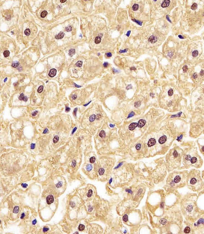 PGK1 / Phosphoglycerate Kinase Antibody - PGK1 Antibody staining PGK1 in human liver tissue sections by Immunohistochemistry (IHC-P - paraformaldehyde-fixed, paraffin-embedded sections). Tissue was fixed with formaldehyde and blocked with 3% BSA for 0. 5 hour at room temperature; antigen retrieval was by heat mediation with a citrate buffer (pH6). Samples were incubated with primary antibody (1/25) for 1 hours at 37°C. A undiluted biotinylated goat polyvalent antibody was used as the secondary antibody.
