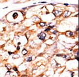 PGK2 Antibody - Formalin-fixed and paraffin-embedded human cancer tissue reacted with the primary antibody, which was peroxidase-conjugated to the secondary antibody, followed by AEC staining. This data demonstrates the use of this antibody for immunohistochemistry; clinical relevance has not been evaluated. BC = breast carcinoma; HC = hepatocarcinoma.