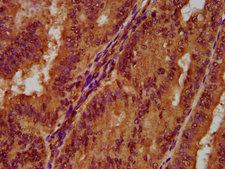 PGLYRP1 / PGRP Antibody - Immunohistochemistry Dilution at 1:300 and staining in paraffin-embedded human endometrial cancer performed on a Leica BondTM system. After dewaxing and hydration, antigen retrieval was mediated by high pressure in a citrate buffer (pH 6.0). Section was blocked with 10% normal Goat serum 30min at RT. Then primary antibody (1% BSA) was incubated at 4°C overnight. The primary is detected by a biotinylated Secondary antibody and visualized using an HRP conjugated SP system.