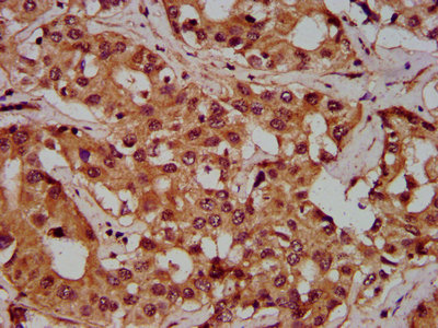 PGLYRP1 / PGRP Antibody - Immunohistochemistry Dilution at 1:300 and staining in paraffin-embedded human liver cancer performed on a Leica BondTM system. After dewaxing and hydration, antigen retrieval was mediated by high pressure in a citrate buffer (pH 6.0). Section was blocked with 10% normal Goat serum 30min at RT. Then primary antibody (1% BSA) was incubated at 4°C overnight. The primary is detected by a biotinylated Secondary antibody and visualized using an HRP conjugated SP system.