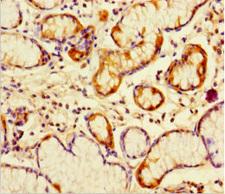 PGLYRP4 Antibody - Immunohistochemistry of paraffin-embedded human gastric cancer using PGLYRP4 Antibody at dilution of 1:100