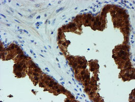 PGM3 Antibody - IHC of paraffin-embedded Carcinoma of Human prostate tissue using anti-PGM3 mouse monoclonal antibody.