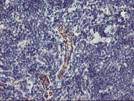 PGM3 Antibody - IHC of paraffin-embedded Human lymphoma tissue using anti-PGM3 mouse monoclonal antibody. (Heat-induced epitope retrieval by 10mM citric buffer, pH6.0, 100C for 10min).