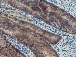 PGM3 Antibody - IHC of paraffin-embedded Adenocarcinoma of Human endometrium tissue using anti-PGM3 mouse monoclonal antibody. (Heat-induced epitope retrieval by 10mM citric buffer, pH6.0, 100C for 10min).