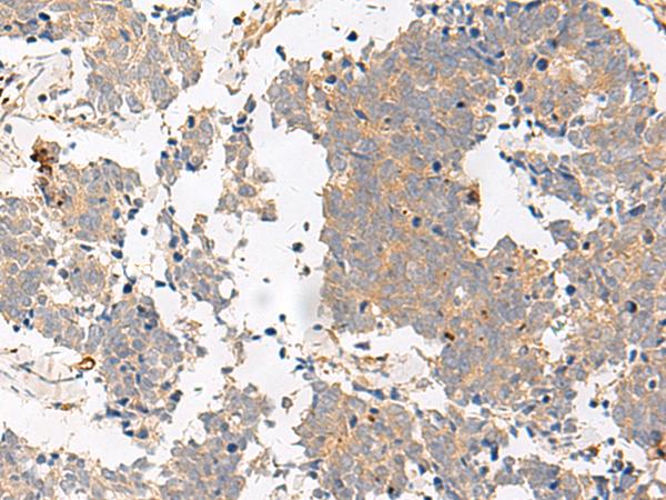 PGR1 / GPR153 Antibody - Immunohistochemistry of paraffin-embedded Human lung cancer tissue  using GPR153 Polyclonal Antibody at dilution of 1:40(×200)
