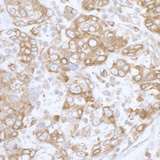 PGRMC1 / MPR Antibody - Detection of human PGRMC1 by immunohistochemistry. Sample: FFPE section of human breast carcinoma. Antibody: Affinity purified rabbit anti- PGRMC1 used at a dilution of 1:5,000 (0.2µg/ml). Detection: DAB