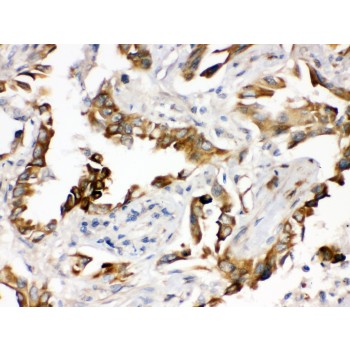 PGRMC1 / MPR Antibody - PGRMC1 antibody IHC-paraffin. IHC(P): Human Lung Cancer Tissue.