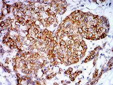 PGRMC1 / MPR Antibody - Immunohistochemical analysis of paraffin-embedded breast cancer tissues using PGRMC1 mouse mAb with DAB staining.