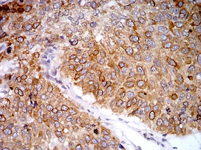 PGRMC1 / MPR Antibody - Immunohistochemical analysis of paraffin-embedded lung cancer tissues using PGRMC1 mouse mAb with DAB staining.