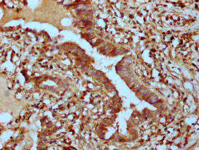 PHACTR1 Antibody - Immunohistochemistry Dilution at 1:400 and staining in paraffin-embedded human lung tissue performed on a Leica BondTM system. After dewaxing and hydration, antigen retrieval was mediated by high pressure in a citrate buffer (pH 6.0). Section was blocked with 10% normal Goat serum 30min at RT. Then primary antibody (1% BSA) was incubated at 4°C overnight. The primary is detected by a biotinylated Secondary antibody and visualized using an HRP conjugated SP system.