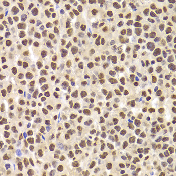 PHAP1 / ANP32A Antibody - Immunohistochemistry of paraffin-embedded Human B cell lymphoma tissue.