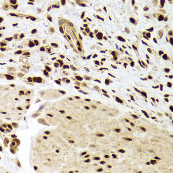 PHAP1 / ANP32A Antibody - Immunohistochemistry of paraffin-embedded Human gastric cancer tissue.