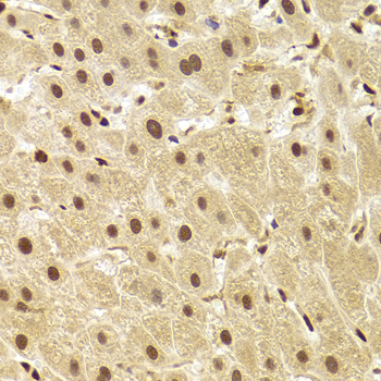 PHAP1 / ANP32A Antibody - Immunohistochemistry of paraffin-embedded Human liver injury tissue.