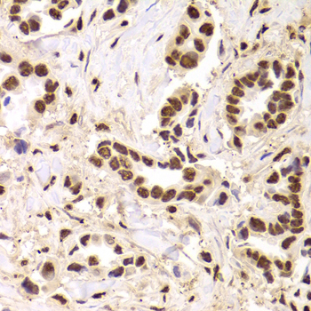 PHAP1 / ANP32A Antibody - Immunohistochemistry of paraffin-embedded Human mammary cancer tissue.