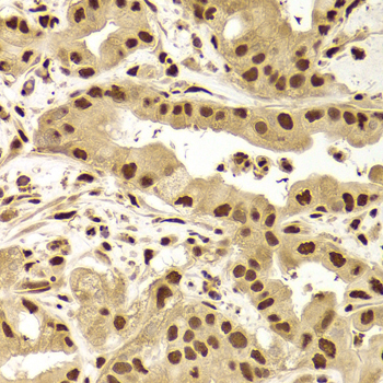 PHAP1 / ANP32A Antibody - Immunohistochemistry of paraffin-embedded liver cancer tissue.