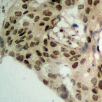 PHAP1 / ANP32A Antibody - Immunohistochemical analysis of PHAP1 staining in human breast cancer formalin fixed paraffin embedded tissue section. The section was pre-treated using heat mediated antigen retrieval with sodium citrate buffer (pH 6.0). The section was then incubated with the antibody at room temperature and detected using an HRP conjugated compact polymer system. DAB was used as the chromogen. The section was then counterstained with hematoxylin and mounted with DPX.