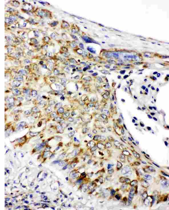 PHB / Prohibitin Antibody - Anti-Prohibitin antibody, IHC(P): Human Lung Cancer Tissue