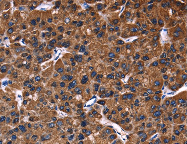 PHB / Prohibitin Antibody - Immunohistochemistry of paraffin-embedded Human liver cancer using PHB Polyclonal Antibody at dilution of 1:30.