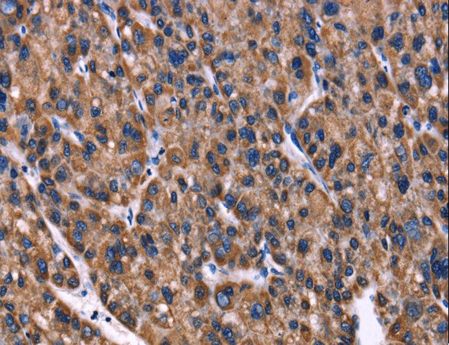 PHB / Prohibitin Antibody - Immunohistochemistry of paraffin-embedded Human liver cancer using PHB Polyclonal Antibody at dilution of 1:40.