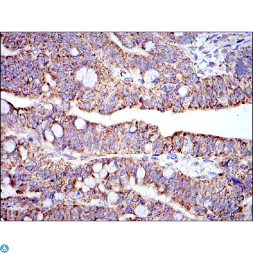 PHB / Prohibitin Antibody - Immunohistochemistry (IHC) analysis of paraffin-embedded rectum cancer tissues with DAB staining using Prohibitin Monoclonal Antibody.
