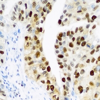 PHC1 / EDR1 Antibody - Immunohistochemical analysis of PHC1 staining in human prostate formalin fixed paraffin embedded tissue section. The section was pre-treated using heat mediated antigen retrieval with sodium citrate buffer (pH 6.0). The section was then incubated with the antibody at room temperature and detected using an HRP conjugated compact polymer system. DAB was used as the chromogen. The section was then counterstained with hematoxylin and mounted with DPX.