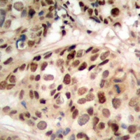 PHF1 Antibody - Immunohistochemical analysis of PHF1 staining in human prostate cancer formalin fixed paraffin embedded tissue section. The section was pre-treated using heat mediated antigen retrieval with sodium citrate buffer (pH 6.0). The section was then incubated with the antibody at room temperature and detected with HRP and DAB as chromogen. The section was then counterstained with hematoxylin and mounted with DPX.