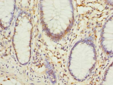 PHF10 Antibody - Immunohistochemistry of paraffin-embedded human colon cancer using antibody at dilution of 1:100.