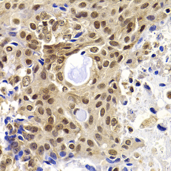 PHF19 Antibody - Immunohistochemistry of paraffin-embedded human oophoroma using PHF19 antibody at dilution of 1:100 (x40 lens).