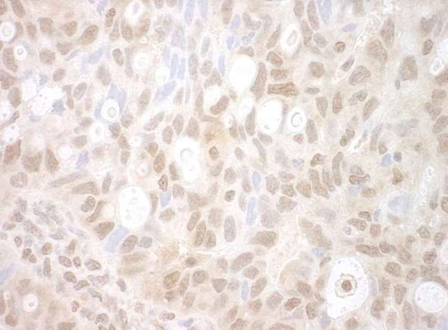 PHF20 Antibody - Detection of Human PHF20 by Immunohistochemistry. Sample: FFPE section of human ovarian carcinoma. Antibody: Affinity purified rabbit anti-PHF20 used at a dilution of 1:250.