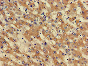 PHF21A / BHC80 Antibody - Immunohistochemistry of paraffin-embedded human liver cancer at dilution of 1:100
