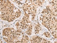 PHF21A / BHC80 Antibody - Immunohistochemistry of paraffin-embedded Human prost at e cancer tissue  using PHF21A Polyclonal Antibody at dilution of 1:50(×200)