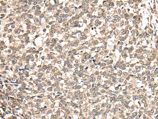 PHF21A / BHC80 Antibody - Immunohistochemistry of paraffin-embedded Human esophagus cancer tissue  using PHF21A Polyclonal Antibody at dilution of 1:50(×200)