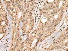 PHF21A / BHC80 Antibody - Immunohistochemistry of paraffin-embedded Human colorectal cancer tissue  using PHF21A Polyclonal Antibody at dilution of 1:50(×200)