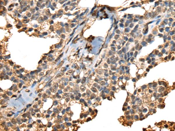 PHF21A / BHC80 Antibody - Immunohistochemistry of paraffin-embedded Human ovarian cancer tissue  using PHF21A Polyclonal Antibody at dilution of 1:50(×200)