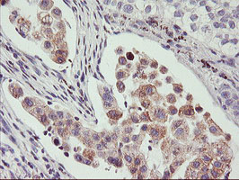 PHF21B Antibody - IHC of paraffin-embedded Carcinoma of Human lung tissue using anti-PHF21B mouse monoclonal antibody.