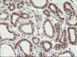 PHF21B Antibody - IHC of paraffin-embedded Carcinoma of Human thyroid tissue using anti-PHF21B mouse monoclonal antibody.