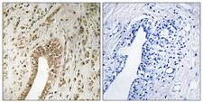 PHF3 Antibody - Immunohistochemistry analysis of paraffin-embedded human breast carcinoma tissue, using PHF3 Antibody. The picture on the right is blocked with the synthesized peptide.