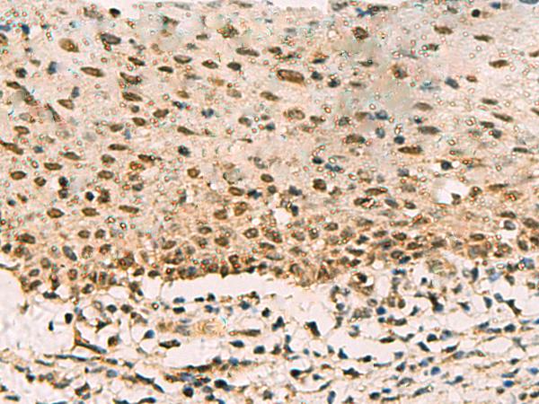 PHF5A / INI Antibody - Immunohistochemistry of paraffin-embedded Human cervical cancer tissue  using PHF5A Polyclonal Antibody at dilution of 1:90(×200)