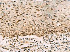 PHF5A / INI Antibody - Immunohistochemistry of paraffin-embedded Human cervical cancer tissue  using PHF5A Polyclonal Antibody at dilution of 1:90(×200)