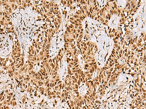 PHF5A / INI Antibody - Immunohistochemistry of paraffin-embedded Human ovarian cancer tissue  using PHF5A Polyclonal Antibody at dilution of 1:55(×200)
