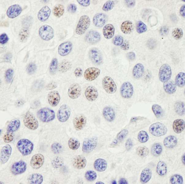 PHF6 Antibody - Detection of Human PHF6 by Immunohistochemistry. Sample: FFPE section of human breast carcinoma. Antibody: Affinity purified rabbit anti-PHF6 used at a dilution of 1:200 (1 ug/ml). Detection: DAB.