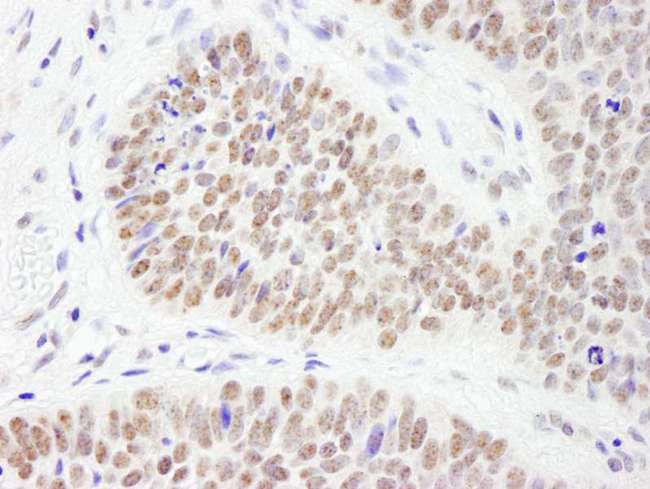 PHF6 Antibody - Detection of Human PHF6 by Immunohistochemistry. Sample: FFPE section of human skin carcinoma. Antibody: Affinity purified rabbit anti-PHF6 used at a dilution of 1:200 (1 ug/ml). Detection: DAB.