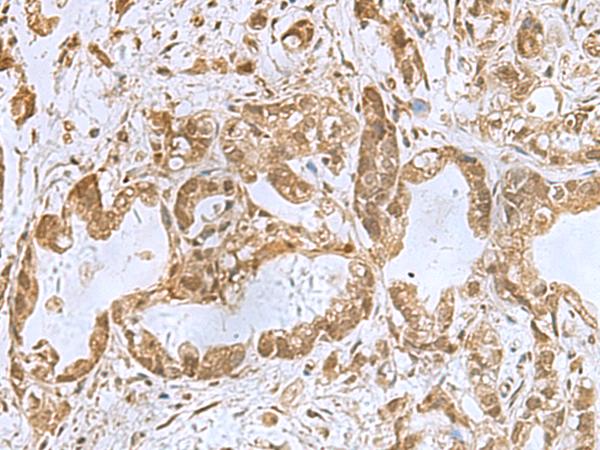 PHF6 Antibody - Immunohistochemistry of paraffin-embedded Human gastric cancer tissue  using PHF6 Polyclonal Antibody at dilution of 1:85(×200)